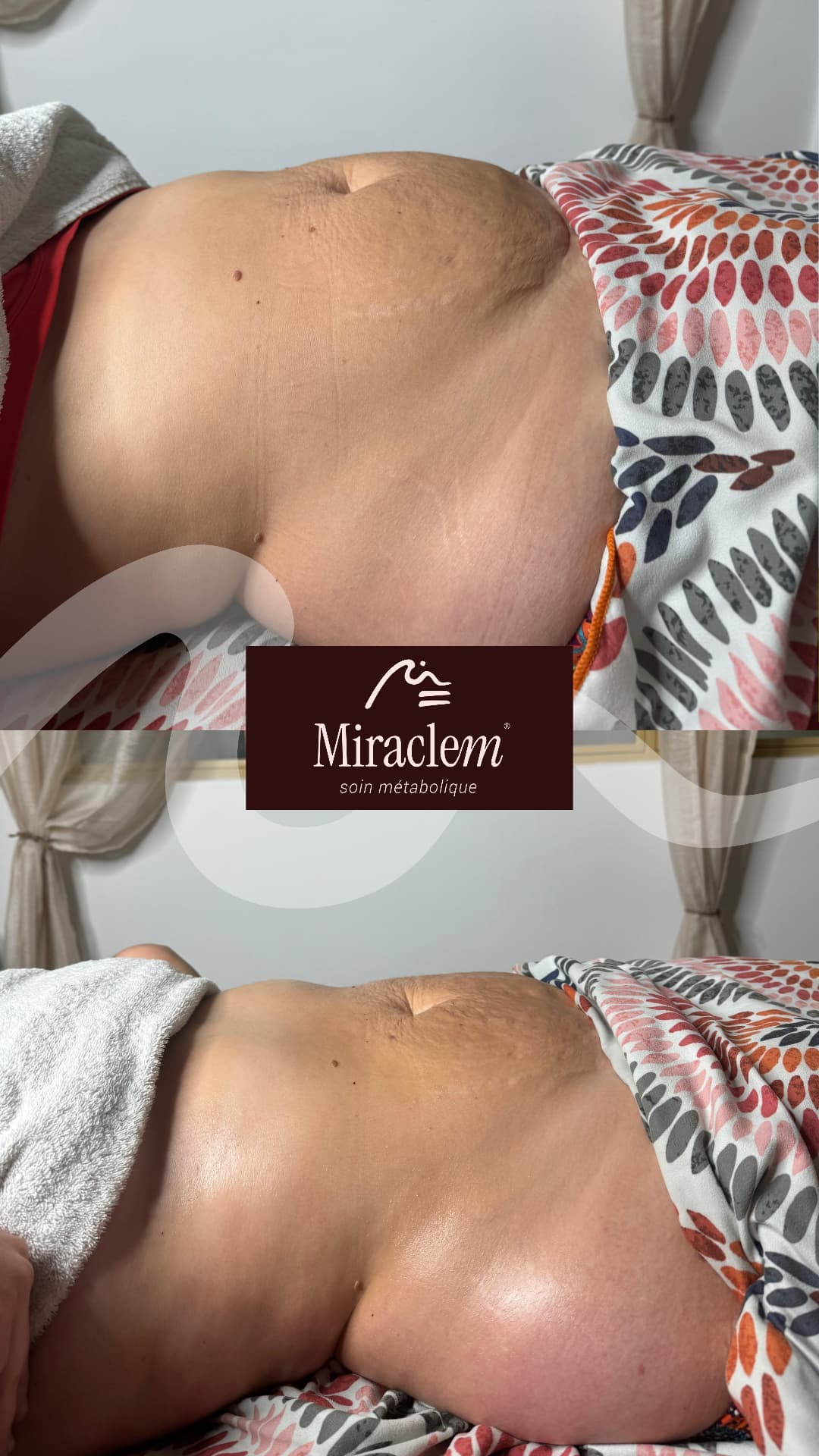 Résultat Miraclem : Post-grossesse · 1 séance